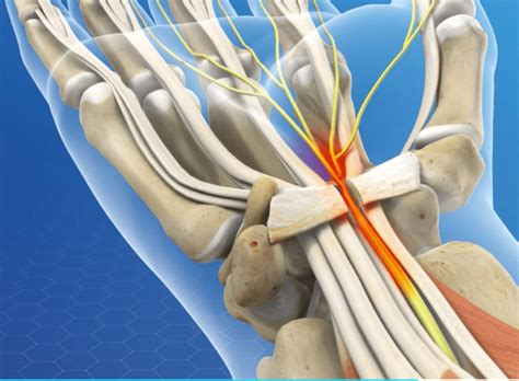 Carpal Tunnel Release Recovery Time