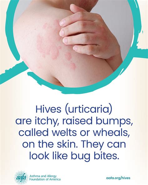 Hives (Urticaria): Know the Facts | Asthma and Allergy Foundation of America