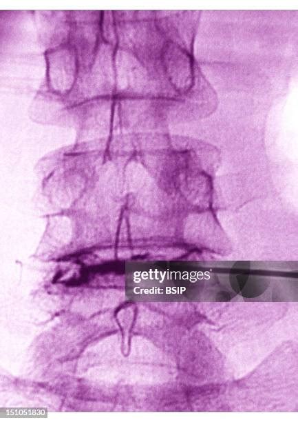 Image result for Lumbar Disc Injection