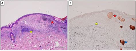 PRAME Is an Effective Tool for the Diagnosis of Nevus-Associated ...