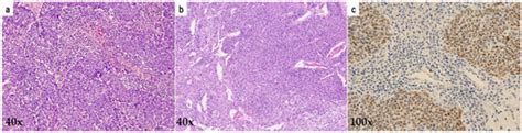 Intra-Tumoral Lymphocytic Infiltration Is Associated with Favorable ...