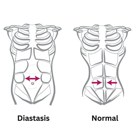 Non-Surgical Diastasis Recti Treatments Los Angeles CA - Dr. Shounuck Patel | The Patel Center ...