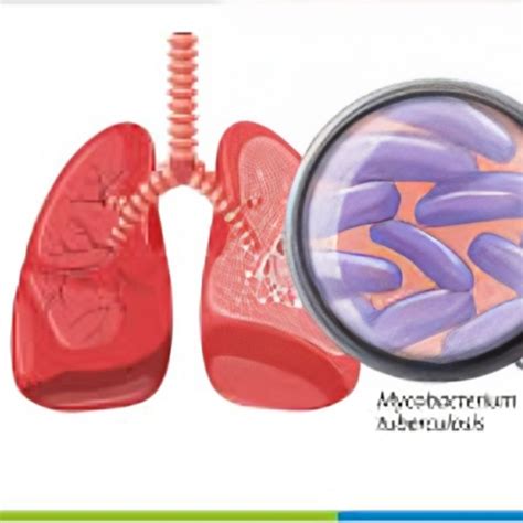 Image result for Tuberculosis Dataset CSV