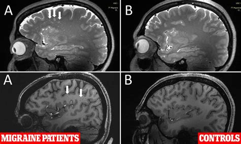 Migraine Brain Vs Normal Brain