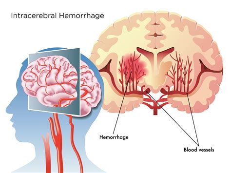 Intracranial Hemorrhage Brain Hemorrhage: Causes, Symptoms, Treatment,