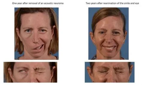 Surgery Restores Eye Muscle Function in Patients With Facial Paralysis