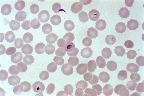 Free picture: photomicrograph, blood smear, ring, stage, plasmodium ...
