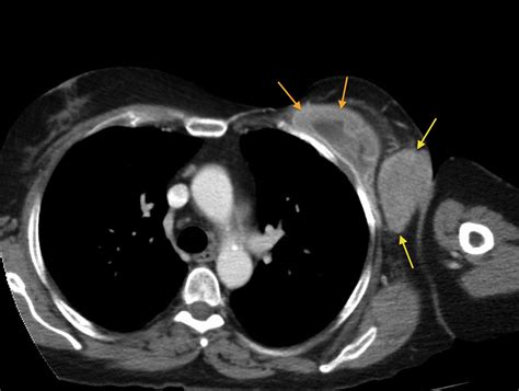 Radiation-induced sarcoma - Radiology at St. Vincent's University Hospital