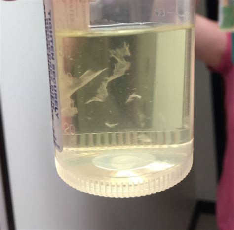 White stuff in pee | BabyCenter