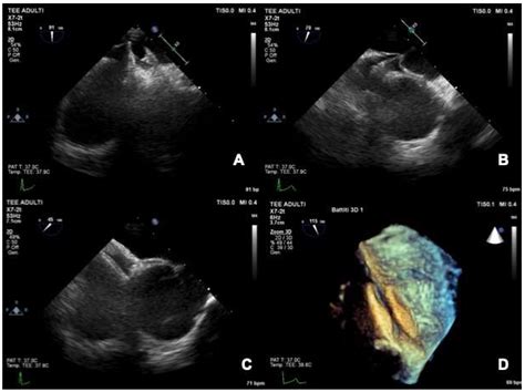 PFO Defect 的图像结果