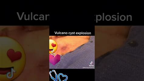 Image result for boils cysts abscesses exploding