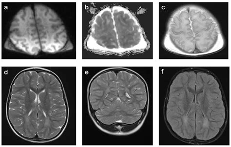Lyme Disease Brain Lesions