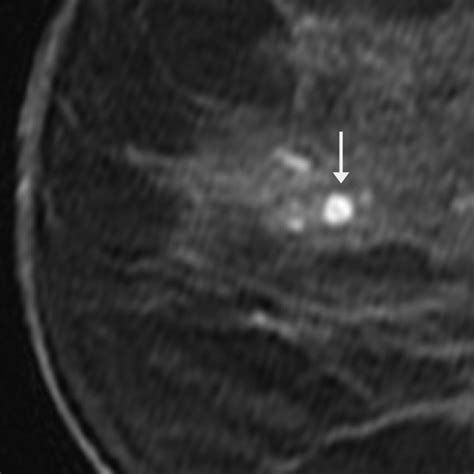 Papilloma Diagnosed at MRI-Guided Vacuum-Assisted Breast Biopsy: Is Surgical Excision Still ...