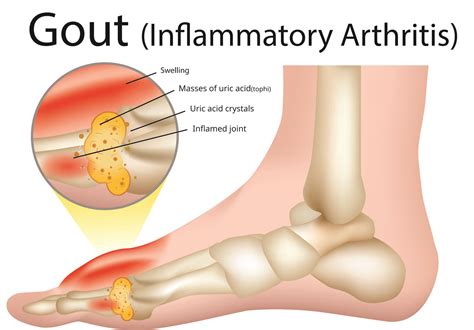 Gout - Family Foot and Ankle Care of Greenville