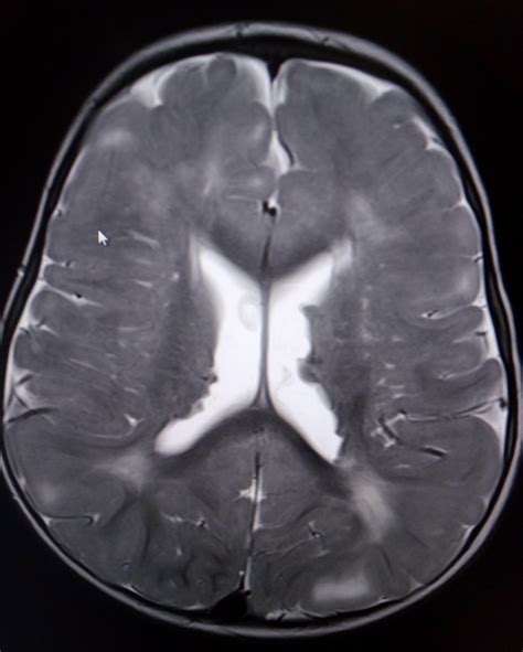 Tuberous Sclerosis : Case Report - Sumer's Radiology Blog