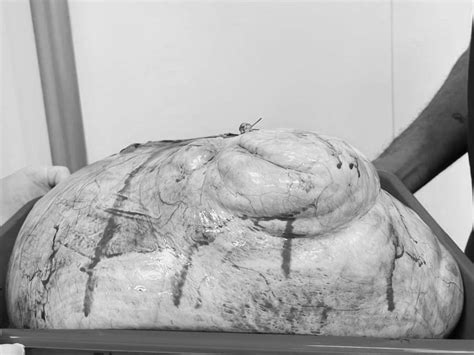 Ahhh... 11 kg tumor in woman's stomach