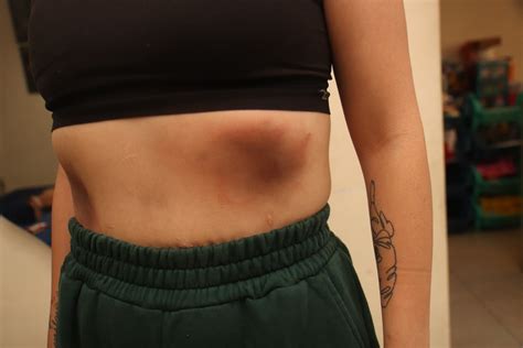 Una costilla fracturada y hasta un diente flojo tiene la mujer que fue ...