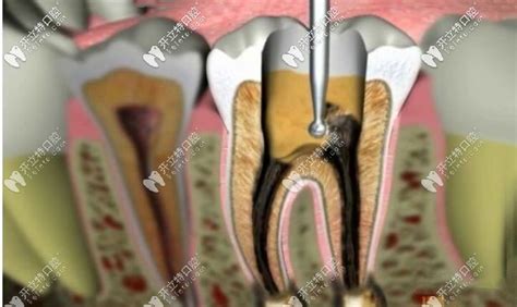 开髓引流术牙神经不在了?不信你看这牙齿开髓引流步骤图 - 清远海棠口腔诊所 - 开立特口腔