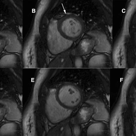 Image result for PVC Localization