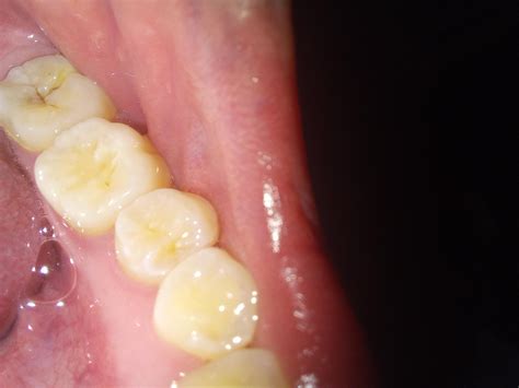 Are those cavities on my molars? Or just stains? : r/Teeth