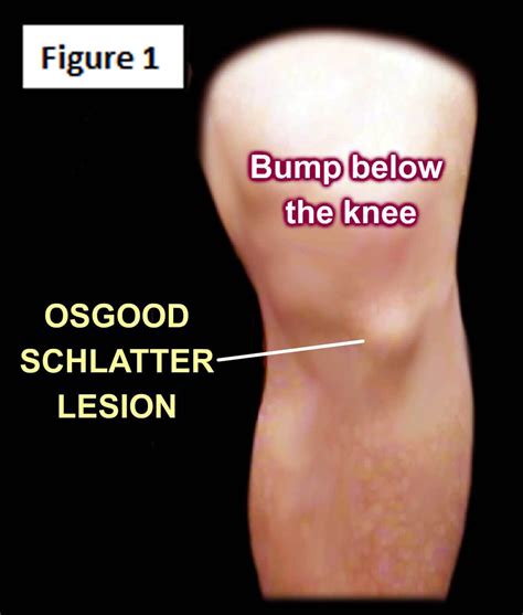 Osgood schlatter disease – Artofit
