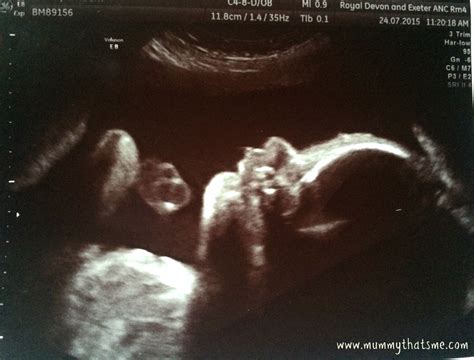 28 Weeks Ultrasound