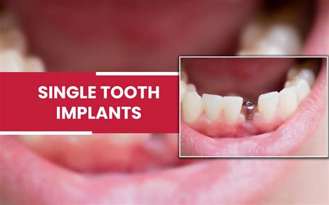 Single Tooth Dental Implant | Wilmot Family Dentistry