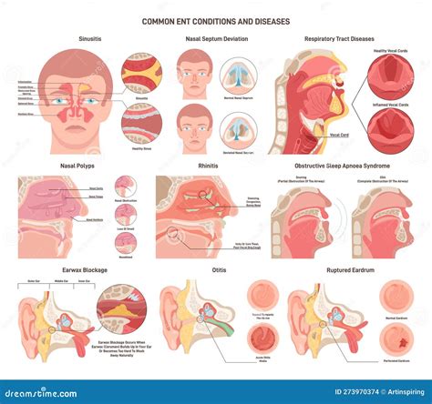Common ENT Diseases Set. Nose, Throat and Ears Bacterial Infections Stock Illustration ...