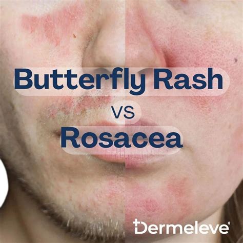 In understanding lupus rashes, it is crucial to differentiate between the butterfly rash ...
