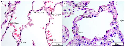 Increase in Alveolar Septal Width Is a Histological Predictor of ...