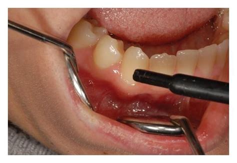 Laser therapy lowers Dentin Hypersensitivity in Periodontally ...