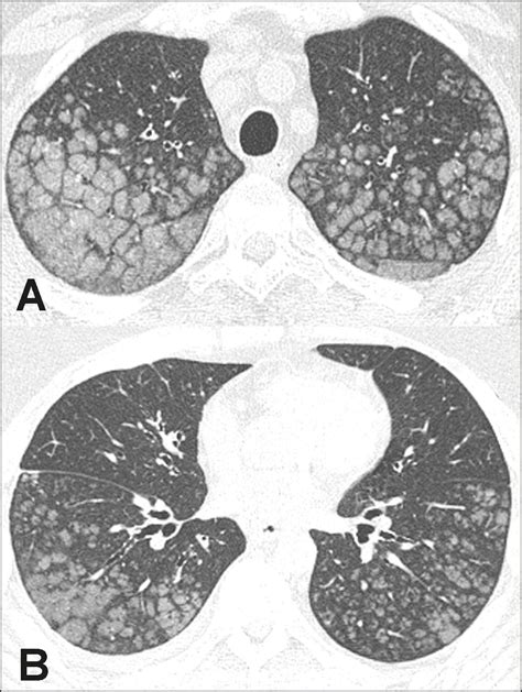 Calcified Lung Adenocarcinoma Ct