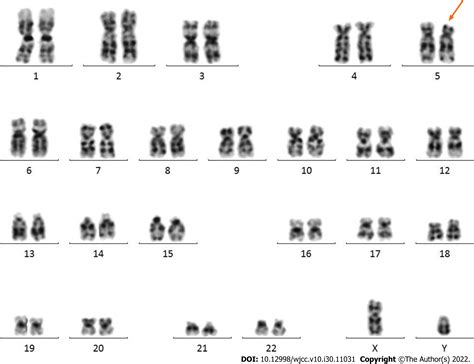 Neonatal Cri du chat syndrome with atypical facial appearance: A case ...