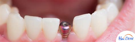 SINGLE TOOTH IMPLANT & SINGLE TOOTH IMPLANT COST IN MUMBAI