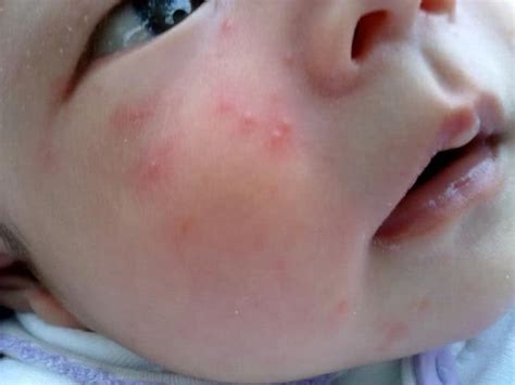 原来婴儿成长过程中会出这么多种痘子疹子！_宝宝