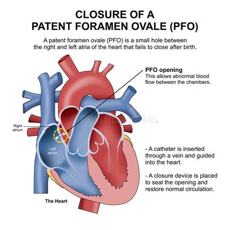 PFO Defect 的图像结果
