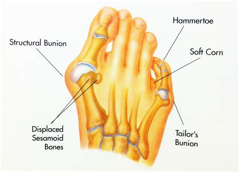 Hammertoes | Foot & Ankle Doctors, Inc.