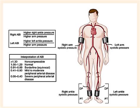 Ankle-Brachial Index Procedures Using Unit IX 的图像结果