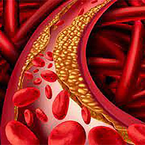 The Hellenic Atherosclerosis Society guidelines on dyslipidemia ...