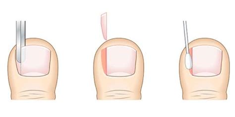 Full Toenail Extraction 的图像结果