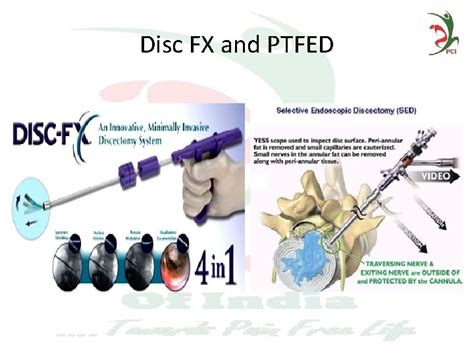 Image result for Disc FX Procedure