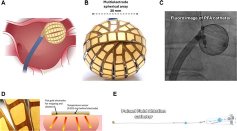 AF ablation using a novel “single-shot” map-and-ablate spherical array ...