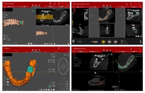 Accuracy, Labor-Time and Patient-Reported Outcomes with Partially ...