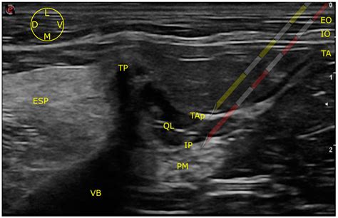 Genitofemoral Nerve Block Ultrasound