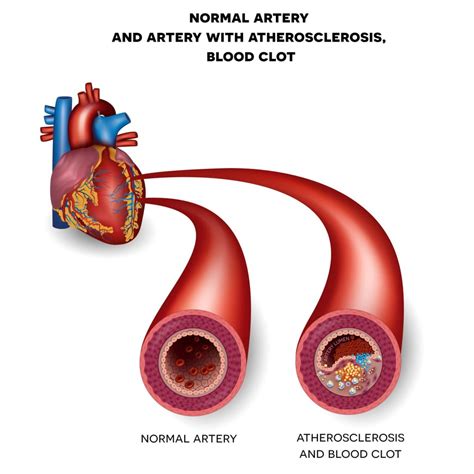 How Do They Check Your Heart for Blockages? - Cardiac Screen