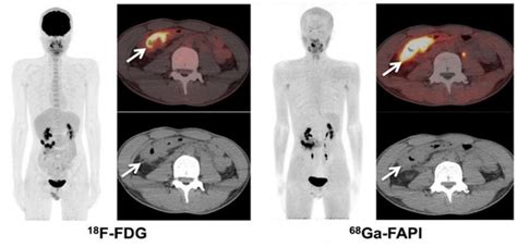FAPI PET/CT in Diagnostic and Treatment Management of Colorectal Cancer ...