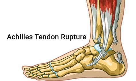 Early walking in a brace for Achilles tendon rupture safe and effective ...