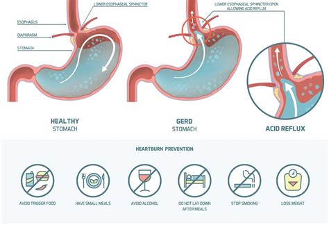 Too Much Acid In Stomach | Stomach Acid Levels Symptoms - PING