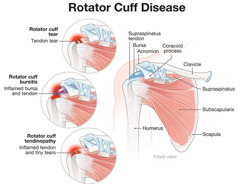 Rotator Cuff Tear Symptoms