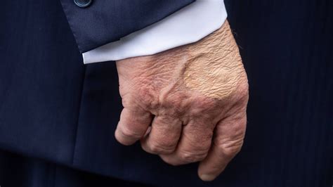 Trump diagnosed with chronic venous insufficiency after undergoing ...